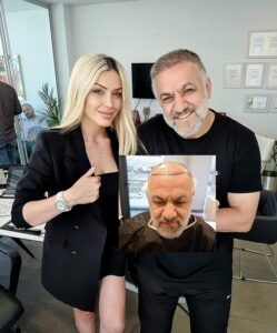 DHI saç ekimi öncesi ve sonrası sonuçları