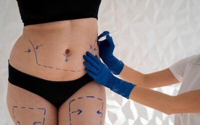 Liposuction Nedir? Yağ Aldırma ile Vücut Şekillendirme Rehberi